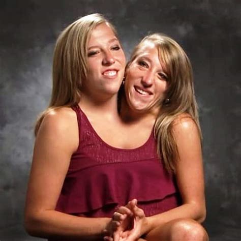 nude conjoined twins|conjoined twins Search